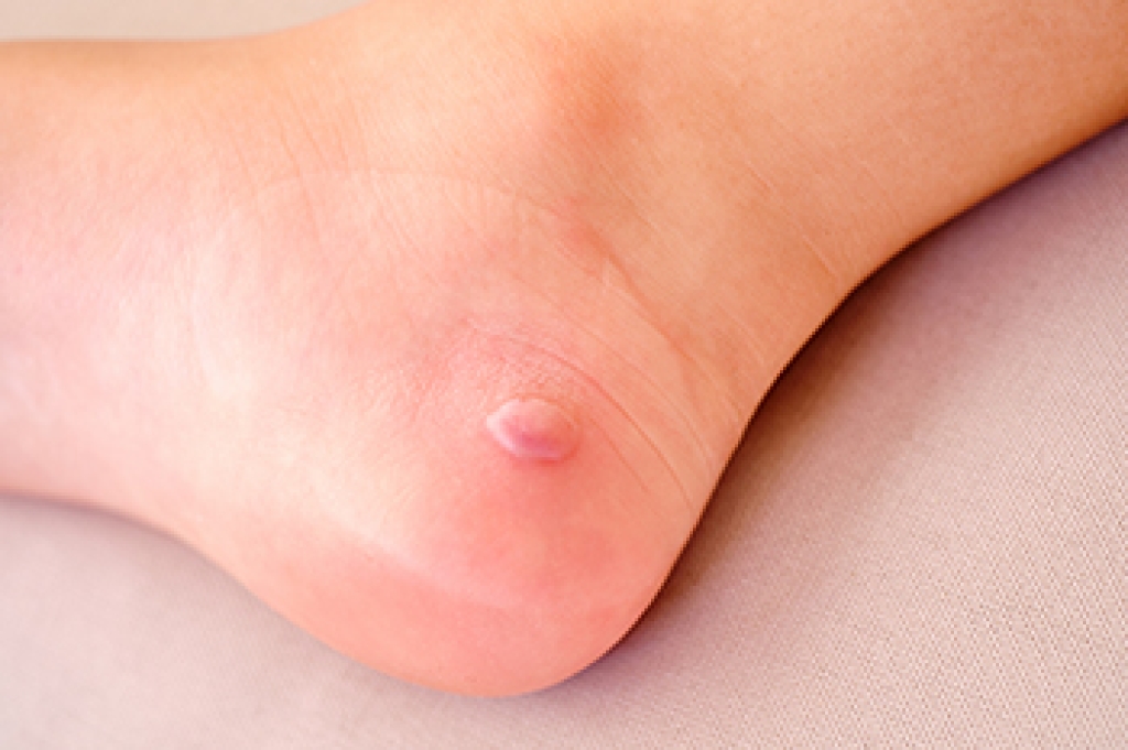 Painful Blisters