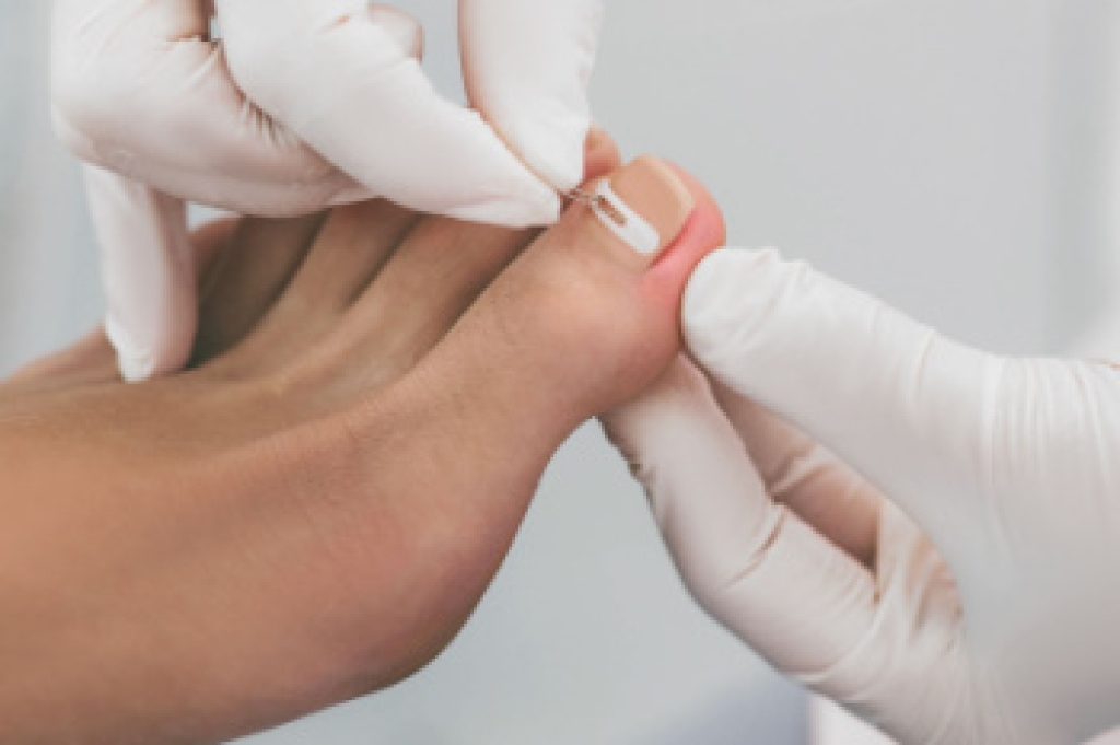 Ingrown Toenails Causes and How Podiatrists Treat Them