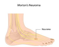 Diagnosing Morton's Neuroma
