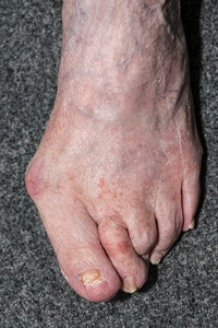 Possible Treatment for Bunions