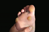 Ways to Help Treat the Corns on Your Feet