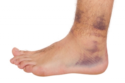 3 Types of Ankle Sprains