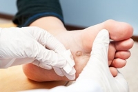 What Are Foot Warts?