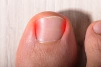 What Can Make Ingrown Toenails More Likely?
